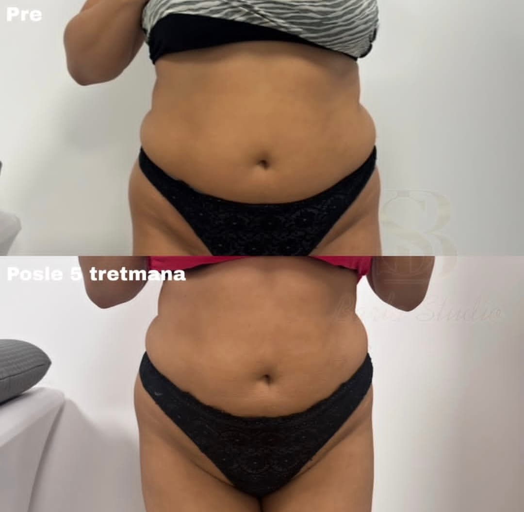 Nega lica i depilacija — LAEL Beauty, Mladenovac, fotografija 7