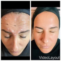 Botox example